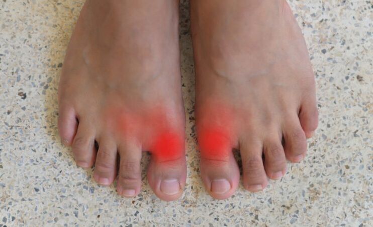 Pain in big toes with gout
